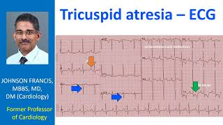 Tricuspid atresia – ECG [upl. by Annatnas47]