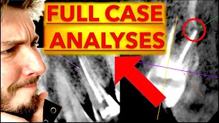 Advanced Dental Radiographs Interpretation CARIES amp Radiolucent LESIONS  OPG Xray 3D CBCT reading [upl. by Goode663]