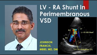 LV  RA Shunt In Perimembranous VSD [upl. by Anaert]