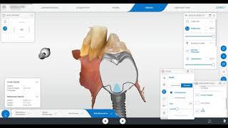 Cerec Implant Crown Design [upl. by Cynthea924]