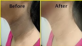 How to treat dark neck  lightening armpits  Whitening neck ummi life diy viral [upl. by Anyak362]