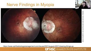 Lecture Glaucoma in the Myopic Eye [upl. by Oremoh]