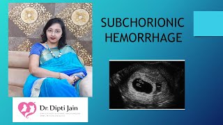 SUBCHORIONIC HAEMORRHAGE Causes amp Treatment [upl. by Niwdla]