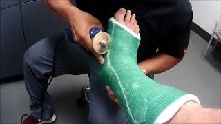 Ankle Injury 2H cast removal skin infection walking boot [upl. by Avir678]