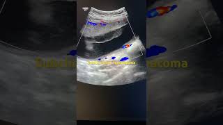 Pregnency ultrasound subchorionic haematoma [upl. by Llehsor]