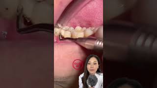 Massive cavity gets scooped out 🍨 cavity bigcavity dentist cavities teethcleaning [upl. by Hovey359]