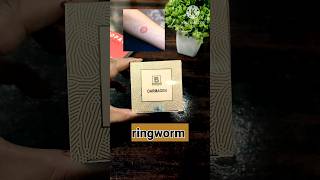 RingwormFungal infection Psoriasis Eczema ringworm eczema psoriasis fungal infection shorts [upl. by Ataner350]