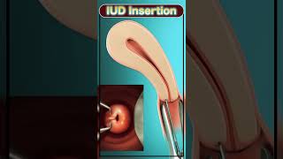 IUD insertion neet biology neetmotivation IUD motivation [upl. by Anelys664]