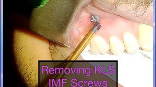 Long Version IMF Screw Removal for Closed Reduction of Mandible Fracture [upl. by Normak]