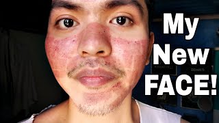 My Fractional CO2 Laser Treatment Experience TAGALOG [upl. by Sabanrab]