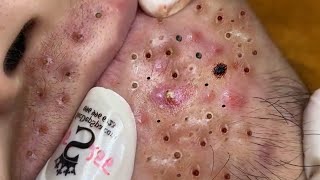 Blackhead Treatment On Chin at Sac Dep Spa [upl. by Aniram223]