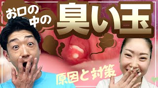 口臭の元！？膿栓臭い玉の原因と予防方法 [upl. by Stavros477]