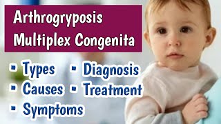 Arthrogryposis Multiplex Congenita AMC  Multiple Newborn Joint Contractures at Birth [upl. by Duff]