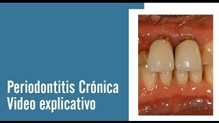 Periodontitis Crónica  Juan Salgado  Enfermedades Periodontales  Video explicativo [upl. by Armil]