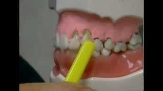 What Causes Gum Recession and How To Treat It [upl. by Bolten]