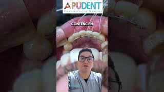 contención fija dentistdoctor dentist dientes doctor tipsdentales dolordental fypシ tips now [upl. by Aeet619]