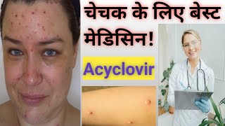 Acyclovir Tablet Uses In Hindi  Treatment For ChickenPox [upl. by Alisa620]