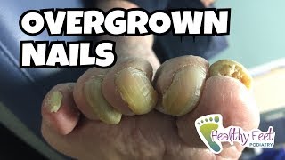 Overgrown Toe Nails [upl. by Shulem]