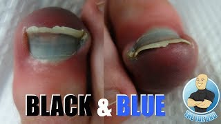 3 FOR 1 SPECIAL  INGROWN TOENAIL BRUISED TOE BLACK NAIL [upl. by Andryc]