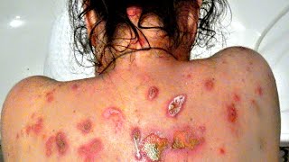 TRUTH EXPOSED ABOUT MORGELLONS [upl. by Aemat]