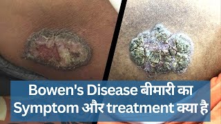 Bowens Disease क्या होता है  चमड़ी में छला का इलाज Thick Skin Rashes on leg  Dr Uttam Ku Lenka [upl. by Atinehc]