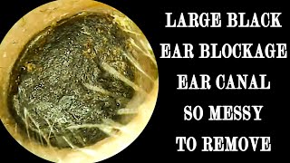 LARGE Black Ear Wax Blockage Ear Canal So Messy To Removal [upl. by Zat]