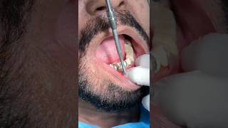 crownremover denture zirconium [upl. by Coyle814]