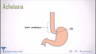 Quick review Achalasia [upl. by Ylloh]