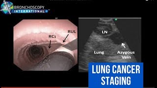 BronchAtlas Distinguishing Lymph Node Station 10R from Station 4R [upl. by Jasmin]