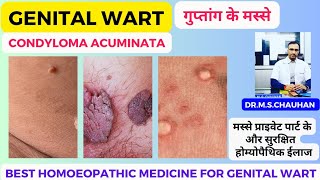 The Ultimate Cure Homeopathic Medicine for Genital Warts [upl. by Godding68]