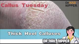 How to Treat a Heel Callus Thick Heel Calluses  Callus Tuesday 11 [upl. by Refinney]