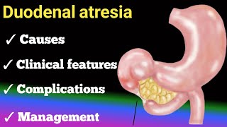 duodenal atresia  causes  clinical features diagnosis  management [upl. by Hnamik336]