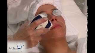 MeDioStar NeXT  Training video for hair removal face from Asclepion [upl. by Demeyer732]