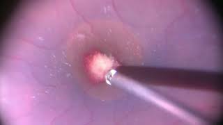 Vitrectomy for Sub ILM blood over macula  Sub ILM blood  20k cutter  Dr Manish Nagpal [upl. by Nagar]