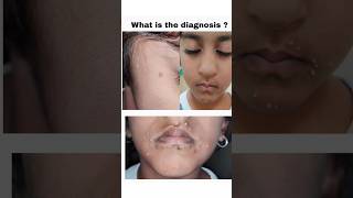 Diagnosis and treatment of Molluscum Contagiosum [upl. by Nabalas]