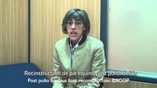 🎓SECUELA de POLIO  CORRECCION DE pie EQUINO por polio [upl. by Okram]