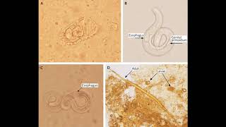 Strongyloides stercoralis  morphology life cycle pathogenesis diagnosis and treatment [upl. by Aldwon]