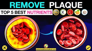 Remove Calcium Plaque from Arteries with THESE Nutrients [upl. by Chapell]