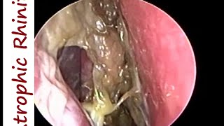 Atrophic Rhinitis Ozaena  Operated Youngs on Left amp Modified Youngs operation on Right [upl. by Anitsyrhc]