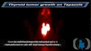 Thyroid Tumor Growth on Tapazole [upl. by Gmur]