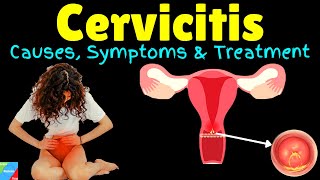 Cervicitis – Symptoms Causes Diagnosis Treatment Complications Prognosis [upl. by Nich828]