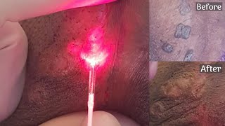 Warts Removal With Advanced Laser Treatment  Laven Clinic Group [upl. by Ericha]