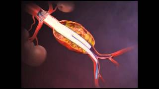 Aneurisma da Aorta Abdominal  AAA  Cirurgia Endovascular [upl. by Notelrahc990]