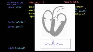 Signs and symptoms of myocarditis and pericarditis [upl. by Eadrahc]