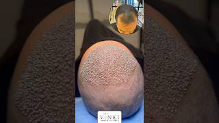 Hair transplant post op for a Norwood 3 without crown hairloss vincihairclinic shorts [upl. by Enined]