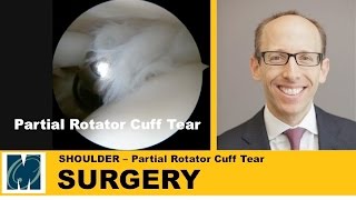 Shoulder Pain  Partial Rotator Cuff Tears [upl. by Hannibal]