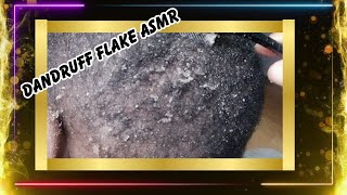 Just Dandruff Flaking It [upl. by Dnomyaw]