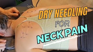 Unleash the Power of Dry Needling for Neck Pain  ASMR [upl. by Ballinger]