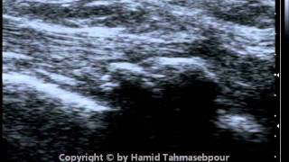 Peroneus Longus Tendon [upl. by Nevram]